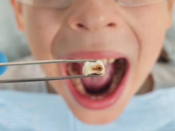 Best Emergency Tooth Extraction in Mayfield, KY